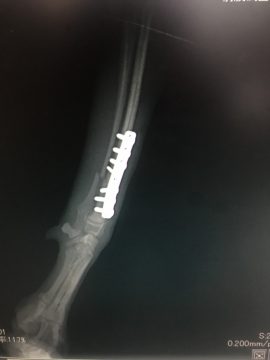 橈尺骨骨折の画像