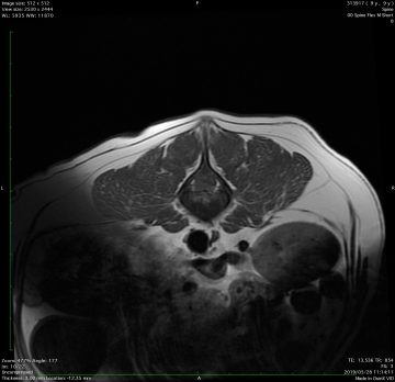 椎間板ヘルニア（片側椎弓切除術）の画像